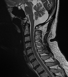 IRM du rachis cervical | Centre d'imagerie Médicale RISF