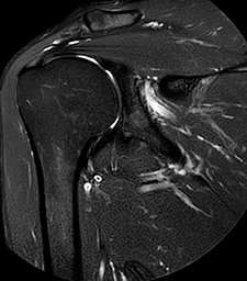 IRM de l'épaule | Centre d'imagerie Médicale RISF