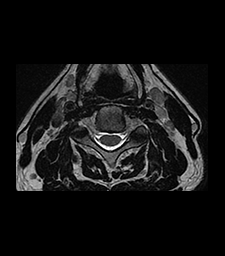 IRM du rachis cervical | Centre d'imagerie Médicale RISF