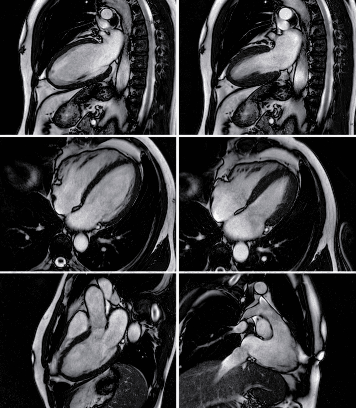 Irm cardiaque (1)